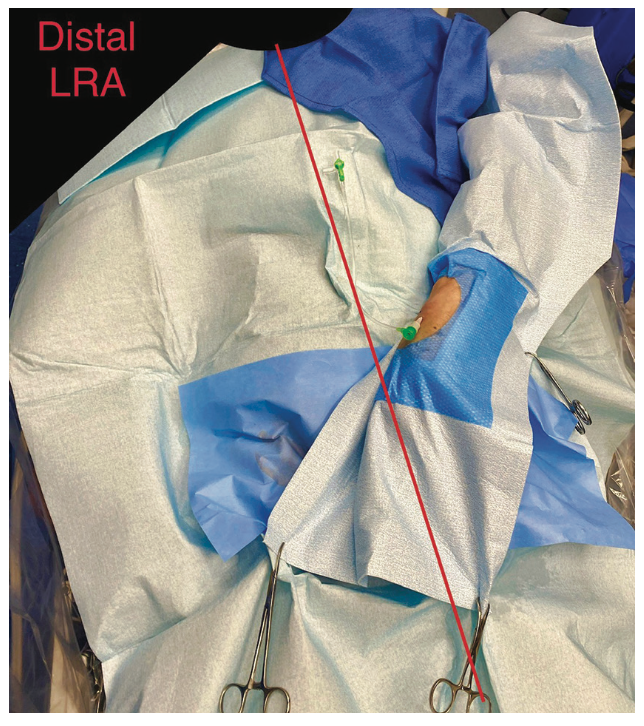 Kinked Catheter Unravelment in the Right Upper Extremity An Unconventional Solution